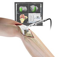 Computer Navigation for Total Knee Replacement