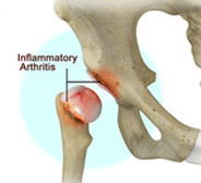 Inflammatory Arthritis of the Hip