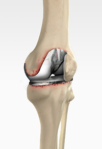 Revision Knee Replacement