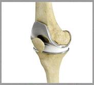 Total Knee Replacement